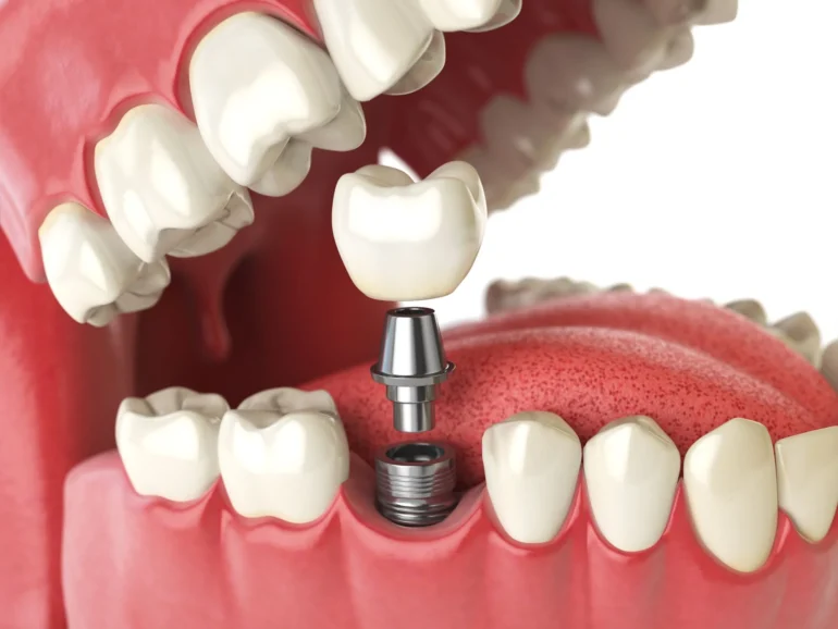 Pain and Discomfort Management Following Dental Implant Implantation